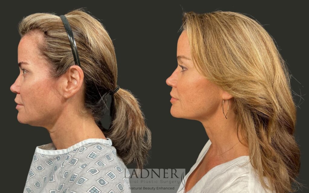 Before and After Image: Brow Lift - left-side