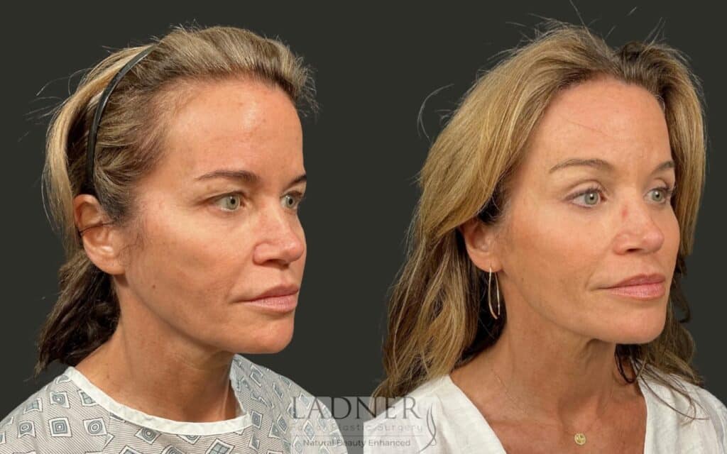 Before and After Image: Brow Lift - right-front-oblique