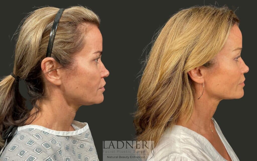 Before and After Image: Brow Lift - right-side