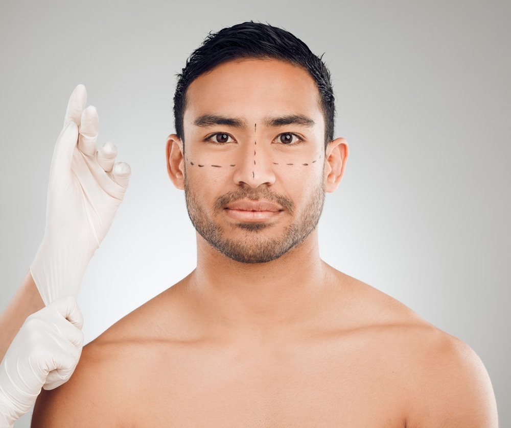 Young man with lines drawn on his face to indicate the facial plastic surgeries he could combine.