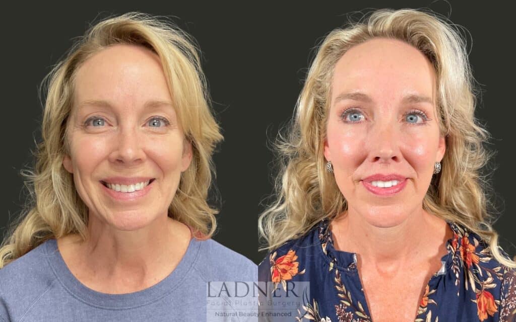 Before and After Image: Ladner Lift, Upper Blepharoplasty, Chin Augmentation, Brow Lift, Lip Lift, CO2, Lower Blepharoplasty Skin Pinch - front