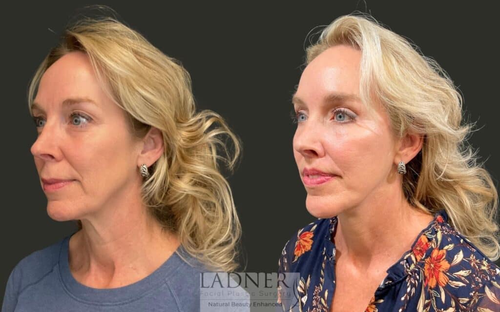 Before and After Image: Ladner Lift, Upper Blepharoplasty, Chin Augmentation, Brow Lift, Lip Lift, CO2, Lower Blepharoplasty Skin Pinch - left-front-oblique