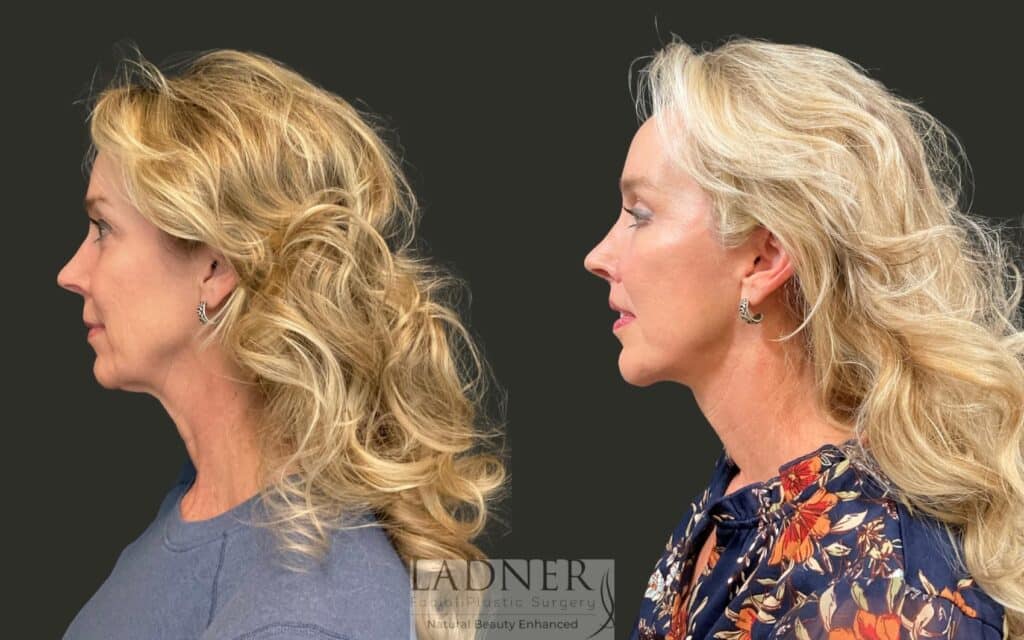 Before and After Image: Ladner Lift, Upper Blepharoplasty, Chin Augmentation, Brow Lift, Lip Lift, CO2, Lower Blepharoplasty Skin Pinch - left-side