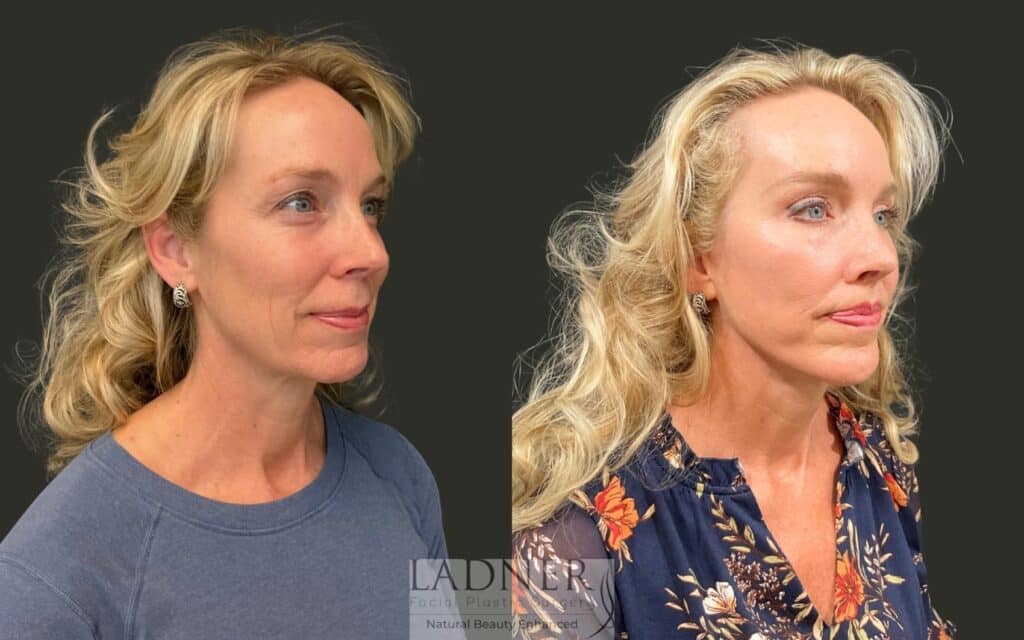 Before and After Image: Ladner Lift, Upper Blepharoplasty, Chin Augmentation, Brow Lift, Lip Lift, CO2, Lower Blepharoplasty Skin Pinch - right-front-oblique