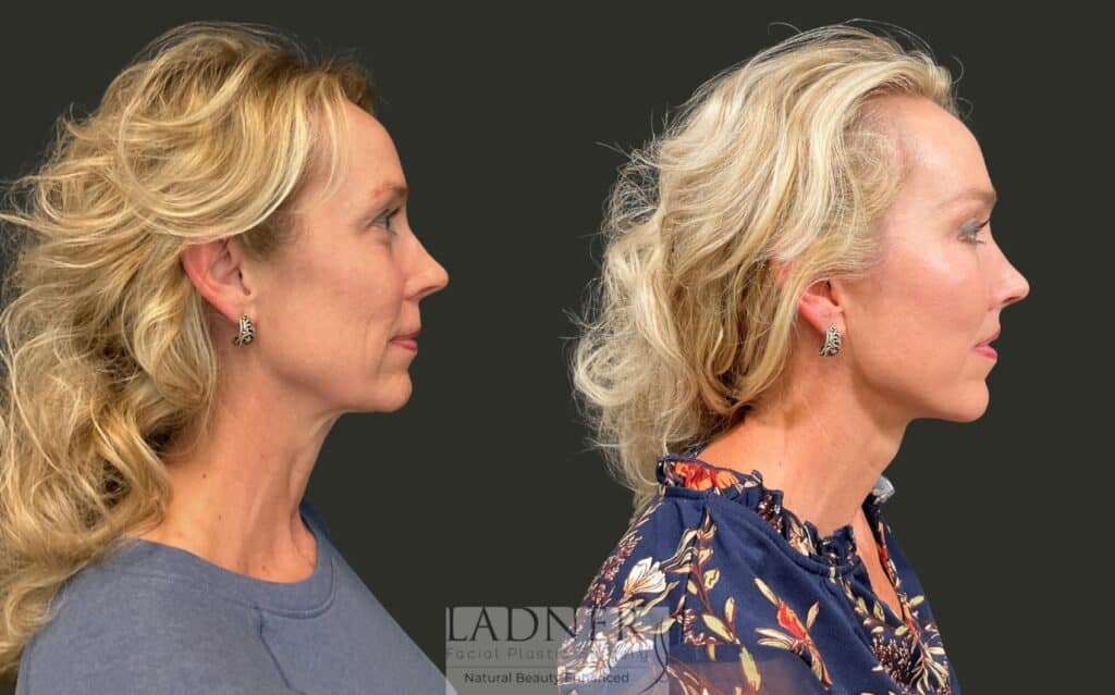 Before and After Image: Ladner Lift, Upper Blepharoplasty, Chin Augmentation, Brow Lift, Lip Lift, CO2, Lower Blepharoplasty Skin Pinch - right-side