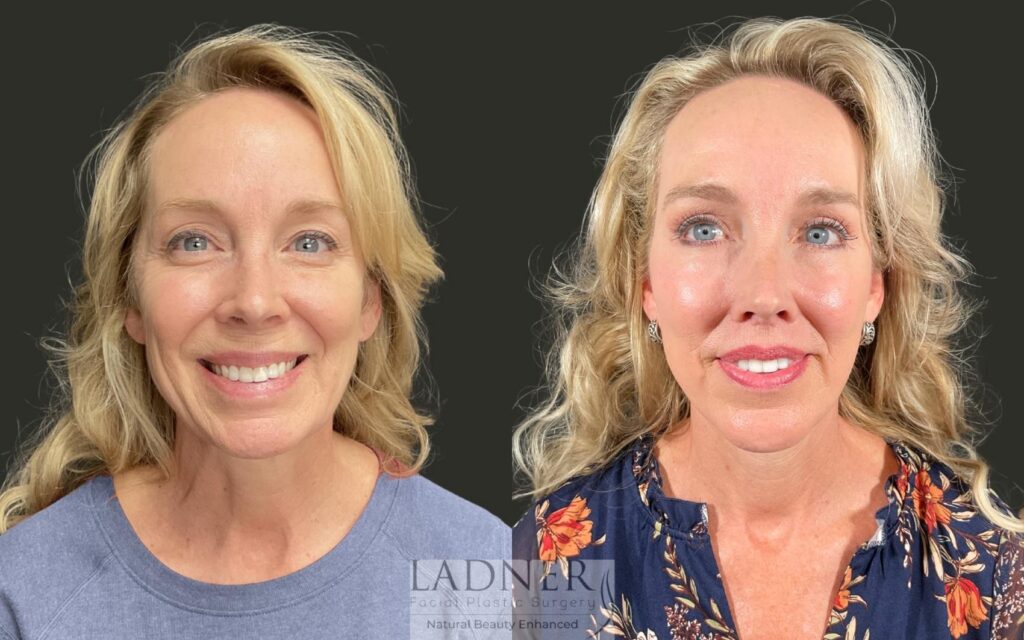 Before and After Image: Deep Plane Facelift, Deep Plane Neck Lift, Upper Bleph, Lower Bleph, Chin Augmentation, Brow Lift, Lip Lift, Perioral CO2, Fat Transfer to Under Eyes - front