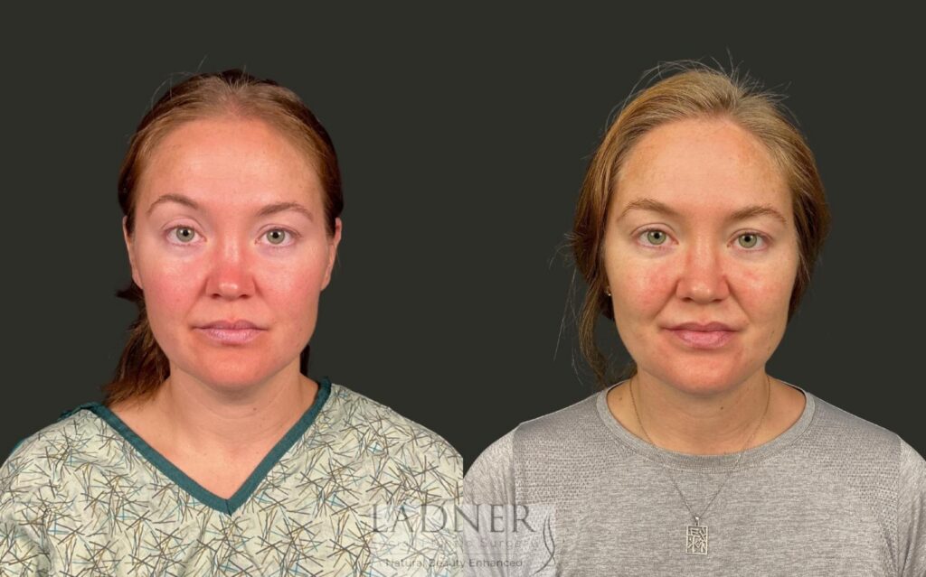 Before and After Image: Minimally Invasive Neck Tightening - front