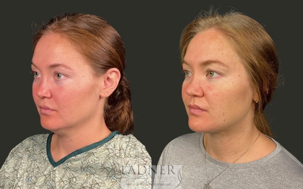 Before and After Image: Minimally Invasive Neck Tightening - left-front-oblique