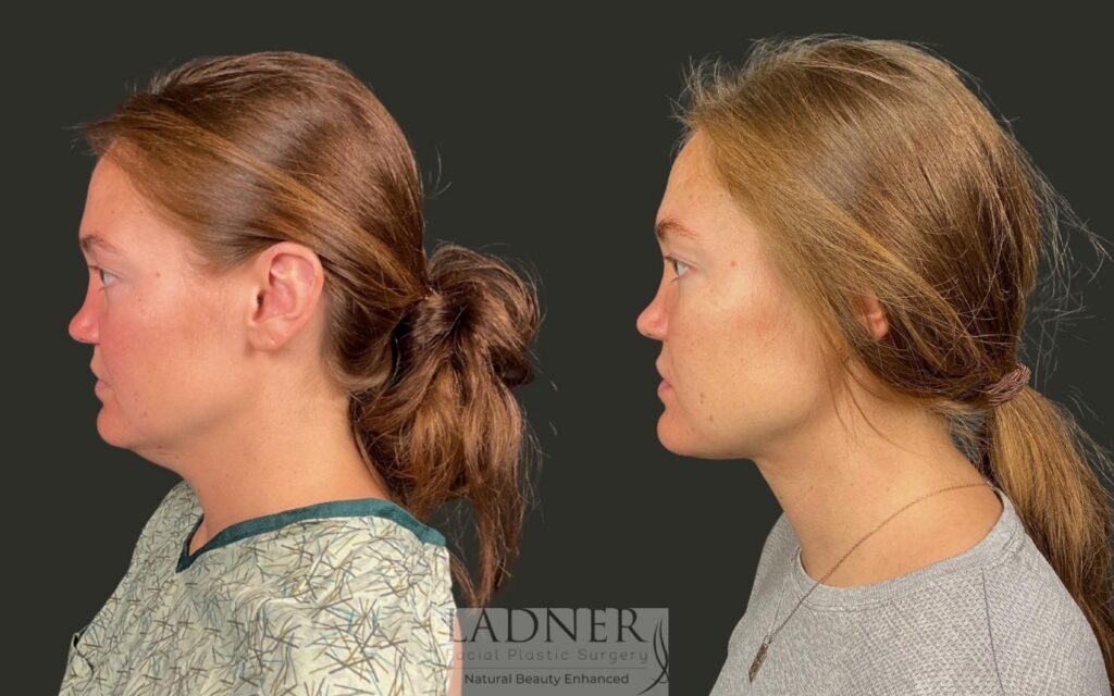 Before and After Image: Minimally Invasive Neck Tightening - left-side