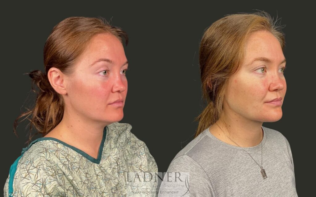 Before and After Image: Minimally Invasive Neck Tightening - right-front-oblique