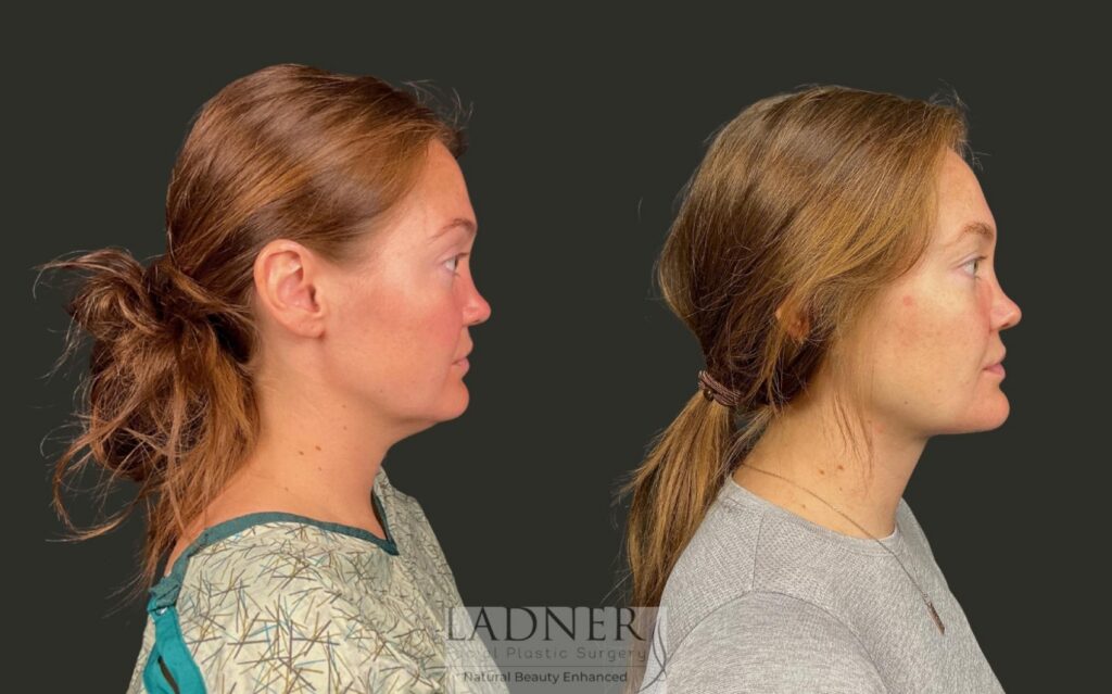 Before and After Image: Minimally Invasive Neck Tightening - right-side